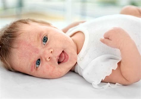 Bebeklerde Alerjik Reaksiyon Belirtileri ve Tedavisi