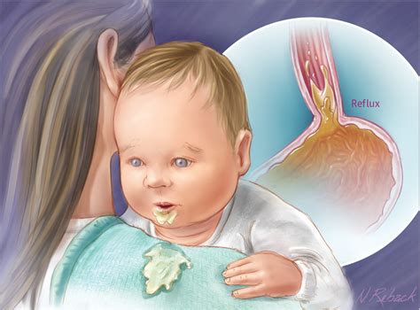 Bebeklerde Reflü Belirtileri, Nedenleri ve Tedavisi